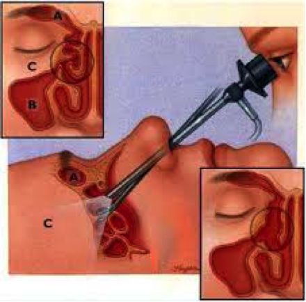 FESS surgery is an advanced