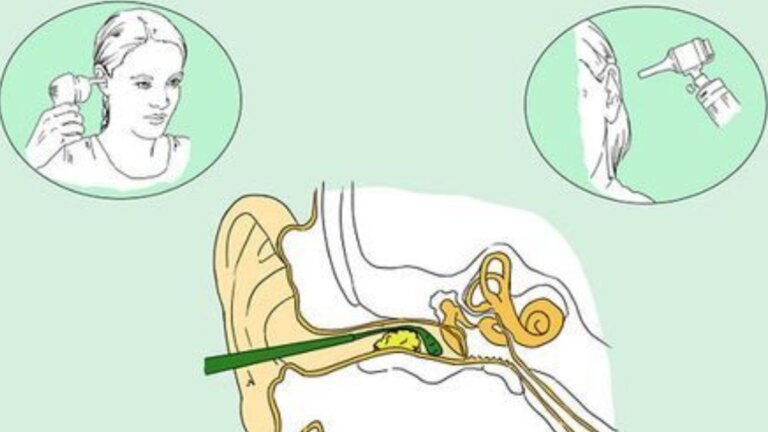 Avoid using sticks or earbuds for ear cleaning. Use drops or gentle wash, or visit an ENT doctor for safe earwax removal.
