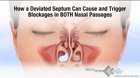 Medical illustration showing a deviated septum causing blockages in both nasal passages by best process explain.