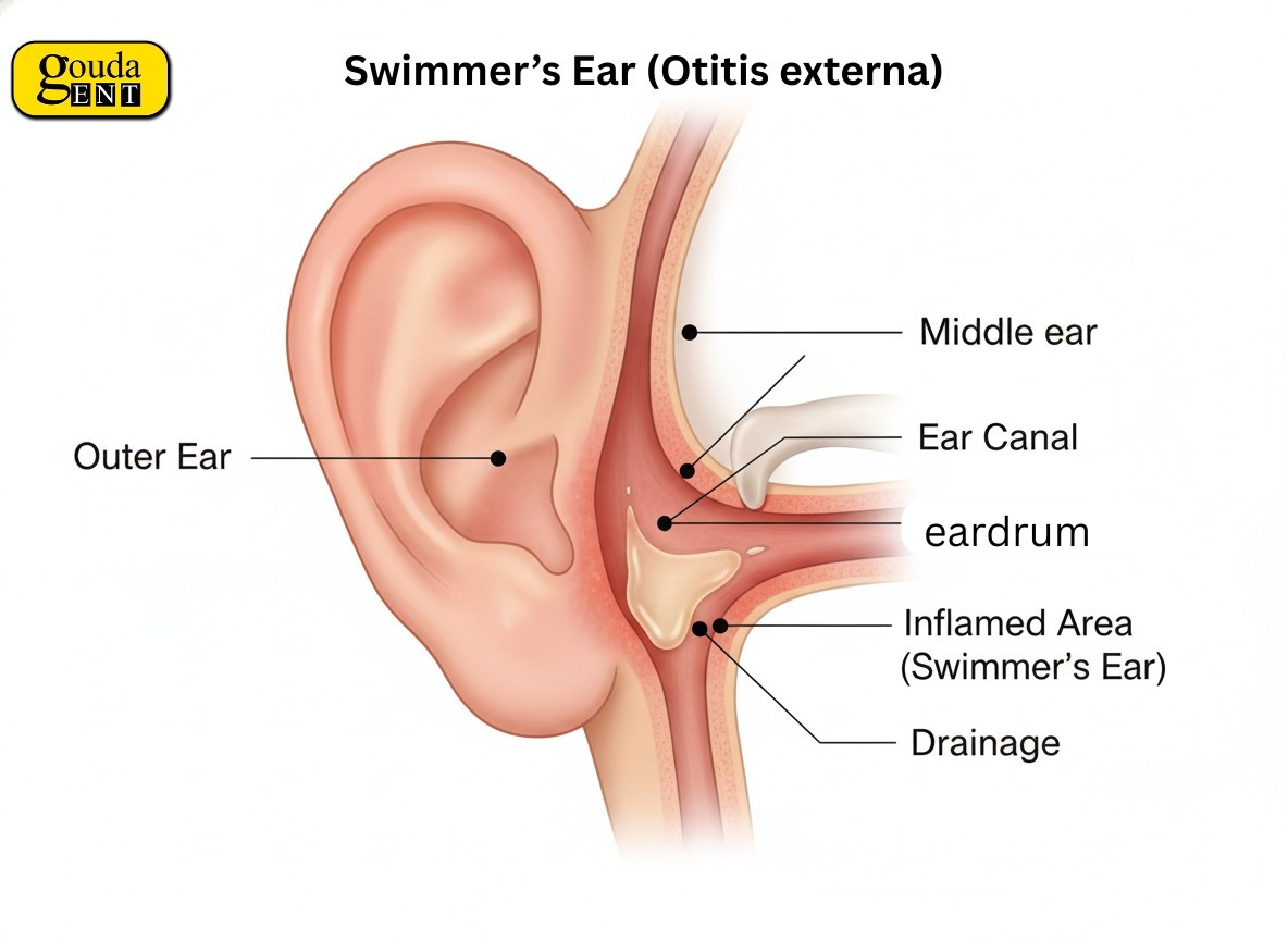 Detailed swimmer’s ear diagram showing ear canal inflammation to support information on How Long Does Swimmer’s Ear Last
